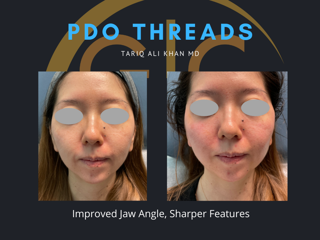 Gentle Care Laser Tustin Before and After picture - PDO Threads